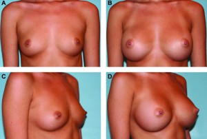 Before and after breast augmentation with IDEAL Implant