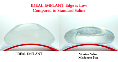 ideal-breast-implant IDEAL structured breast implant