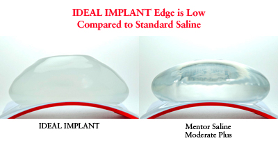 ideal-breast-implant